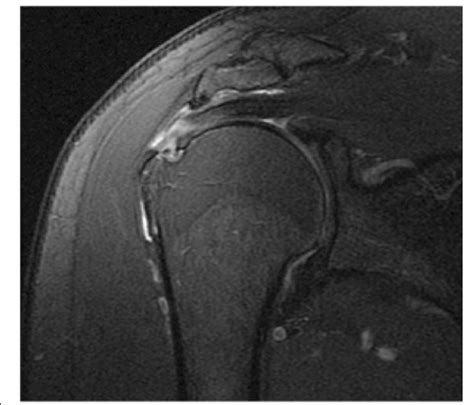 supraspinatus partial tear test|complete rupture of supraspinatus tendon.